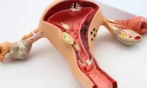 تجربتي مع قسطرة الرحم ومضاعفاتها