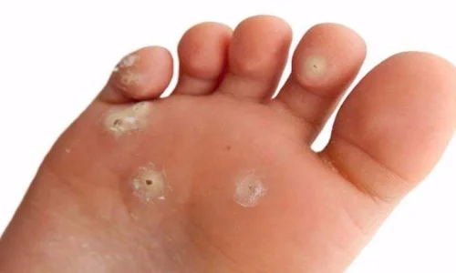 استخدام البصل لعلاج مسمار القدم