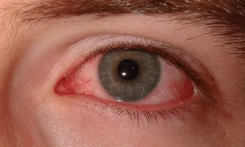 ما تفسيرات ابن سيرين لرؤية الدم في العين في المنام؟