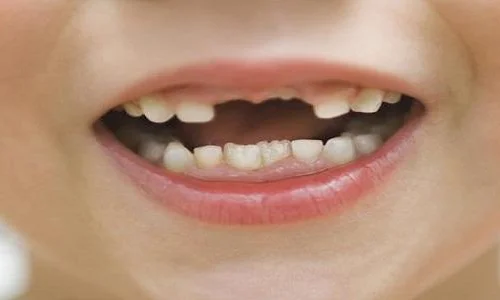 ما تفسيرات رؤية السن الامامي مكسور في المنام؟