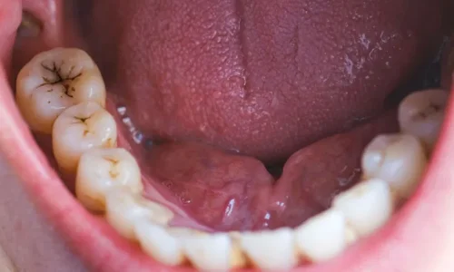 ما تفسير رؤية السوس في الأسنان في المنام؟