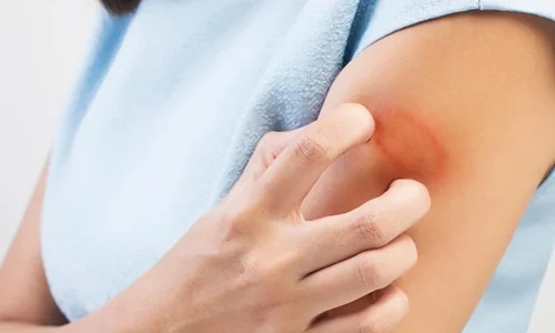 ما تأويل رؤية الطفح الجلدي في المنام للعزباء؟