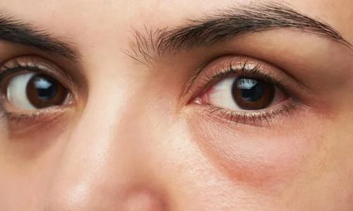 ما تفسير رؤية العين الوارمه في المنام لابن سيرين؟