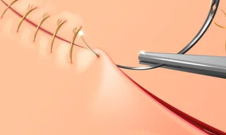 ما تفسير رؤية الغرز الجراحية في المنام لابن سيرين؟