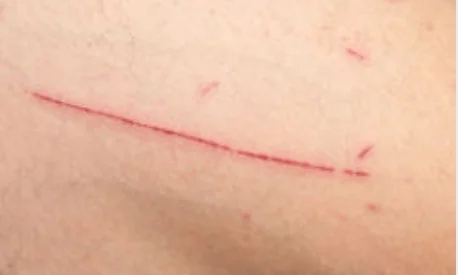 اعرف أهم 20 تفسير لابن سيرين لرؤية الجرح في المنام