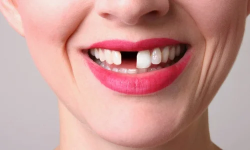 تعرف على تفسير تساقط الأسنان في المنام لابن سيرين