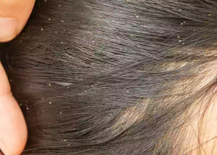 تأويلات ابن سيرين لرؤية القمل في المنام في الشعر