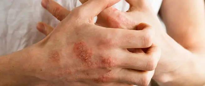 علاج الاكزيما جابر القحطاني