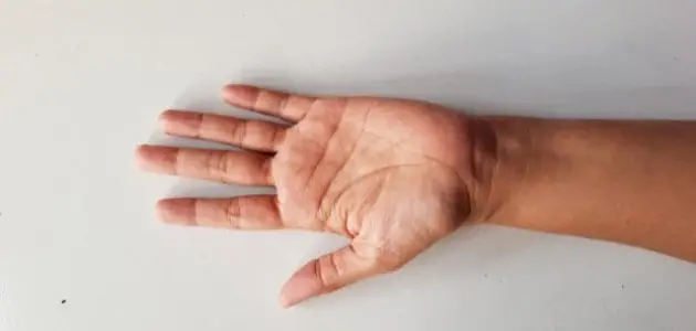 اليد المبتورة في المنام