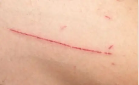 تفسير الجرح في المنام